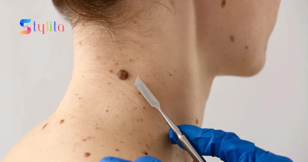 a girl having moles on the back side of her neck