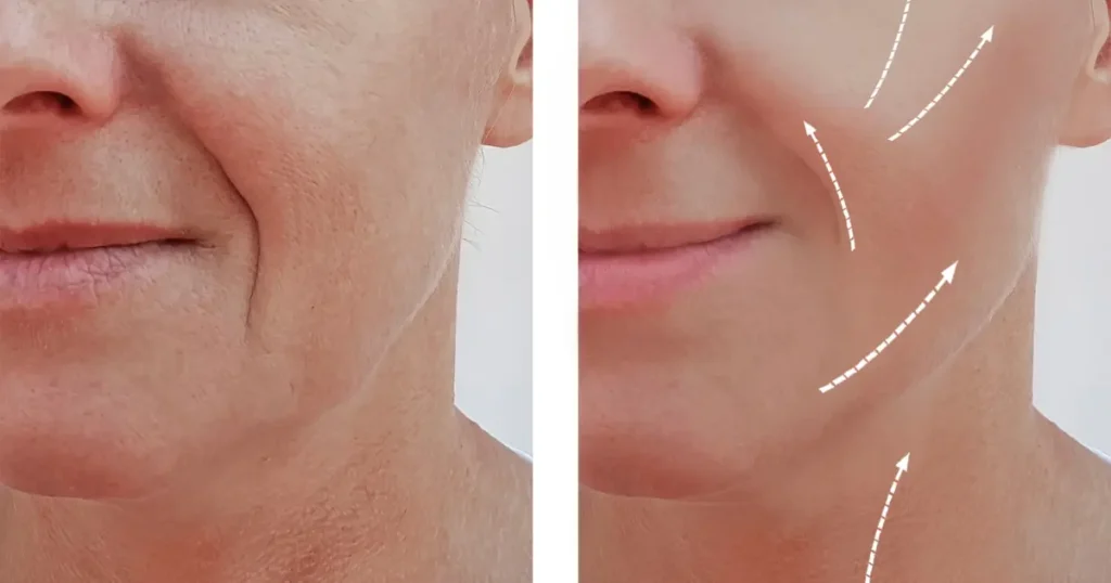 a pic with conditions of a women's face, one with wrinkles and other with wrinkle-free