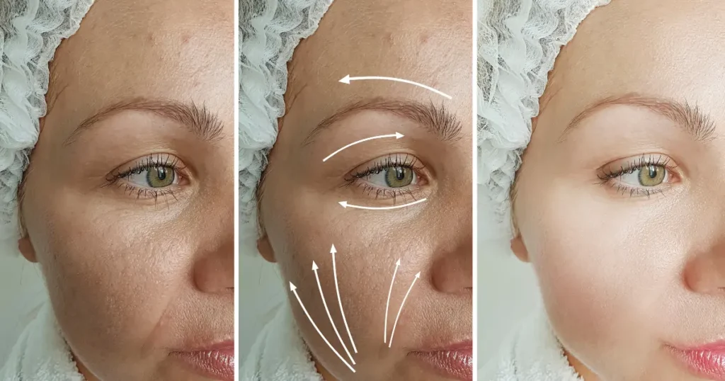 A women's face with three pics, one with wrinkles, second with clearing wrinkles and third wrinkle free