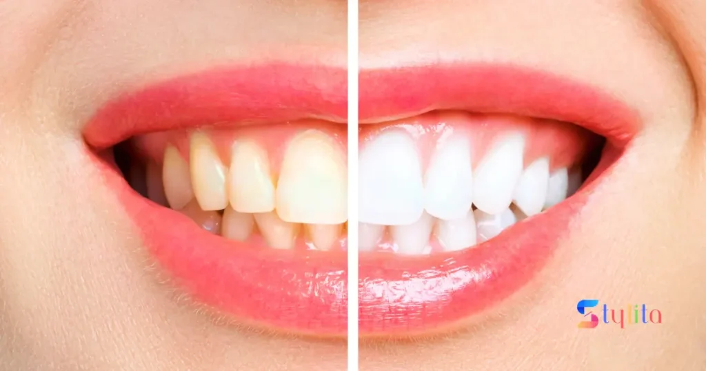 beautiful teeth of a girl with half teeth yellow and half white